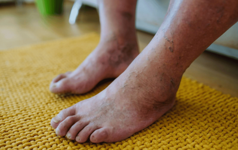 What Does Gangrene Look Like?
