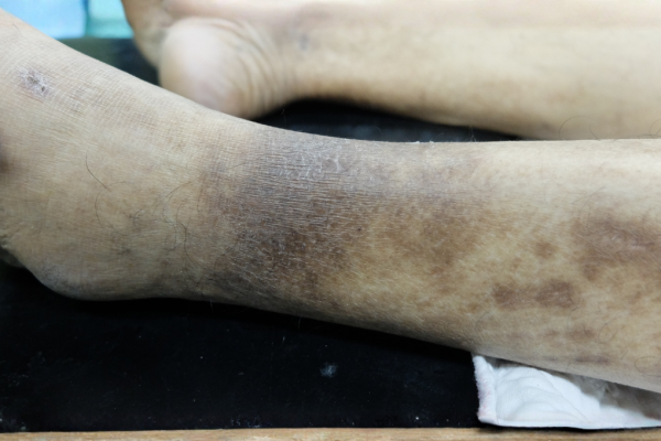 A patient's legs with skin discoloration from peripheral artery disease.