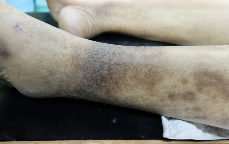 A patient's legs with skin discoloration from peripheral artery disease.