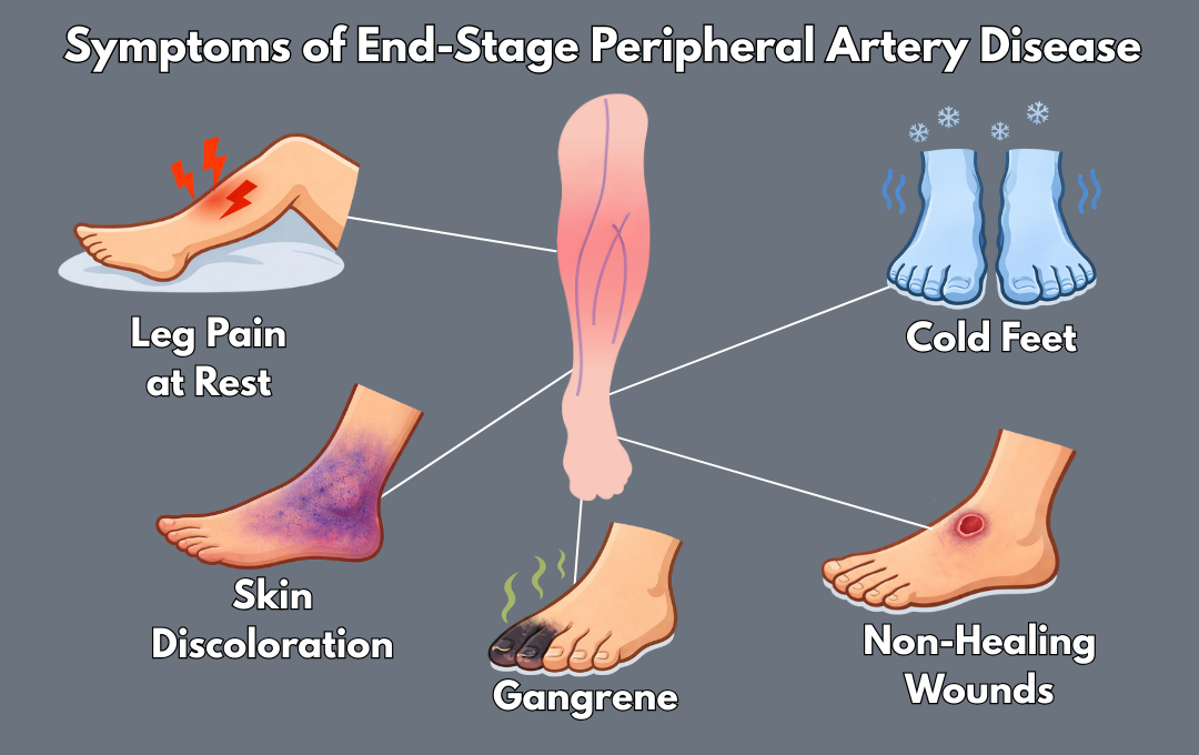 Illustration of the symptoms of end-stage peripheral artery disease.