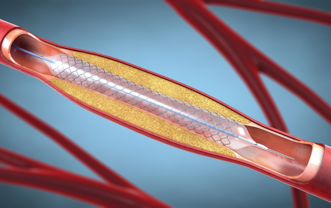Angioplasty and stent placement in action.