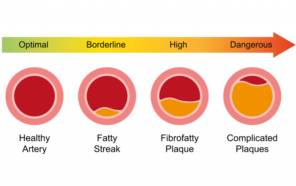 Stages of plaque buildup in the arteries.