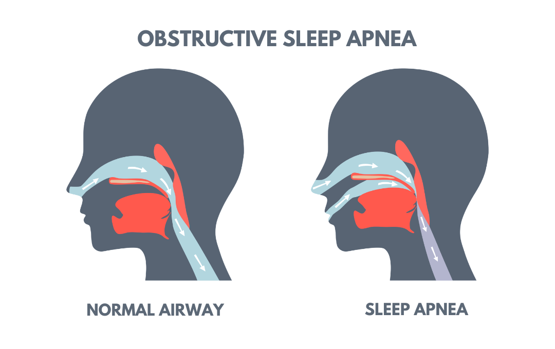 Comparison graphic differentiating normal airways and obstructed airways from sleep apnea, which can contribute to PAD.