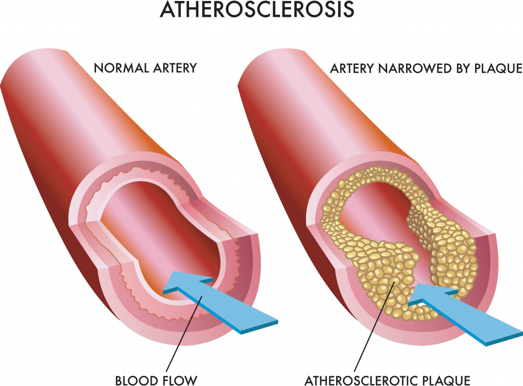 Healthy artery vs. artery with plaque buildup