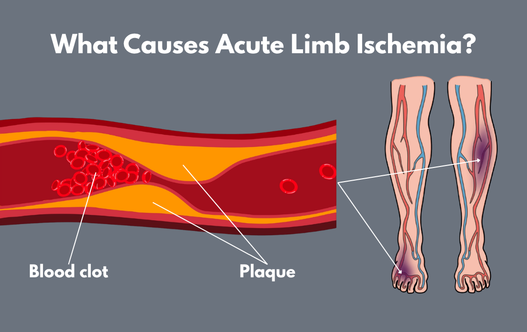 A graphic shows how plaque formation within the arteries can lead to acute limb ischemia and peripheral artery disease.
