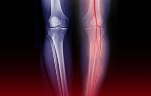 Showing how leg arteries cause pain